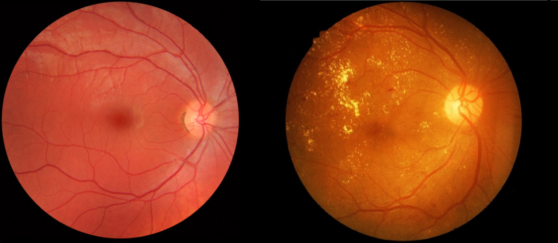 Normal eyeball and then an eyeball affected by diabetic retinopathy